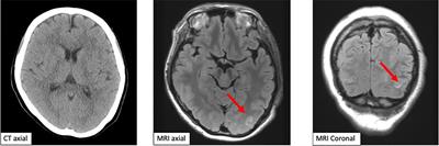 Case report: Posterior reversible encephalopathy syndrome, an adverse effect of lenvatinib and pembrolizumab combination therapy, in a patient with advanced endometrial cancer